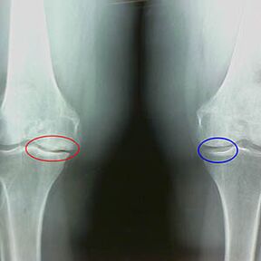 Artrosis de la articulación de la rodilla en la radiografía