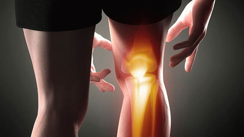 Artrosis de la articulación de la rodilla