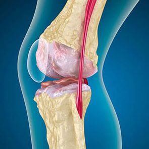 La tensión excesiva del músculo del muslo provoca el dolor en la rodilla
