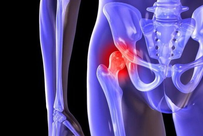 Proceso patológico en la articulación de la cadera con coxartrosis.
