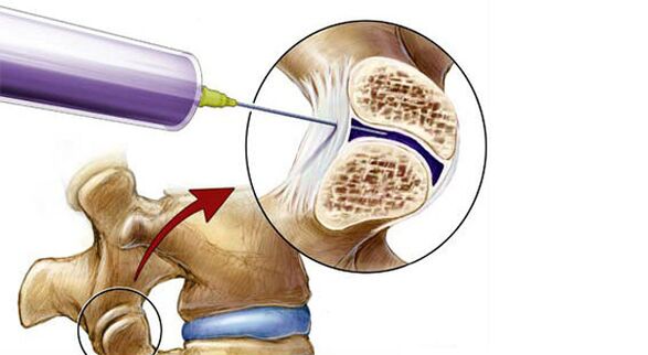 Bloqueo paravertebral para el dolor de espalda.